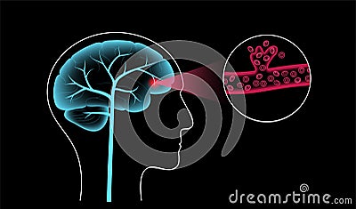 Brain stroke hemorrhagic Vector Illustration