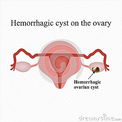 Hemorrhagic cyst on the ovary. Ovary. Infographics. illustration Cartoon Illustration
