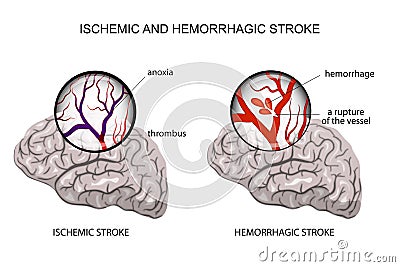 Hemorrhagic and ischemic stroke Vector Illustration