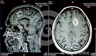 Hemorrhagic stroke Stock Photo