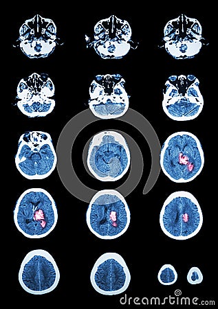 Hemorrhagic Stroke . CT scan (computed tomography) of brain ( c Stock Photo