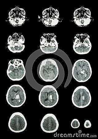 Hemorrhagic Stroke . CT scan (computed tomography) of brain ( c Stock Photo