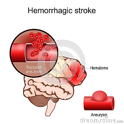 Hemorrhagic stroke. Human brain with Hematoma Vector Illustration