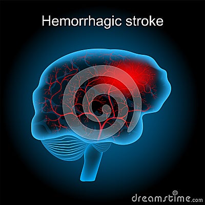 Hemorrhagic stroke. human brain with blood vessels and hematoma Vector Illustration