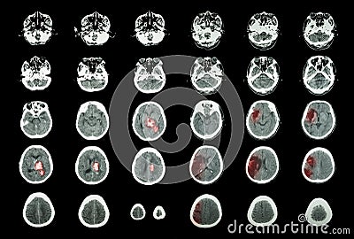 Hemorrhagic Stroke and Ischemic Stroke . CT scan of brain : intracerebral hemorrhage ( 3 left column , cerebral infarction ( 3 ri Stock Photo