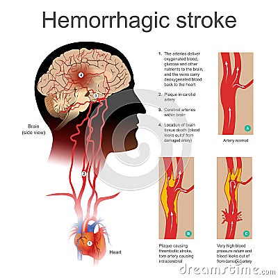 Hemorrhagic stroke. Plaque causing thrombotic stroke torn artery causing intra cerebral. Stock Photo