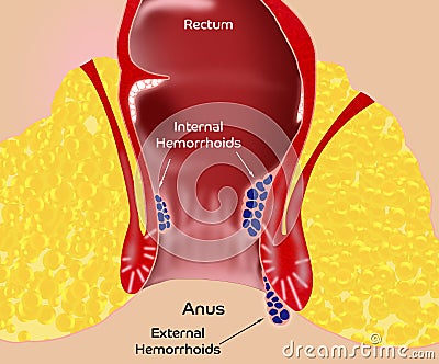 Hemorrhoid. Illustration of unhealthy lower rectum with inflamed vascular structures Stock Photo