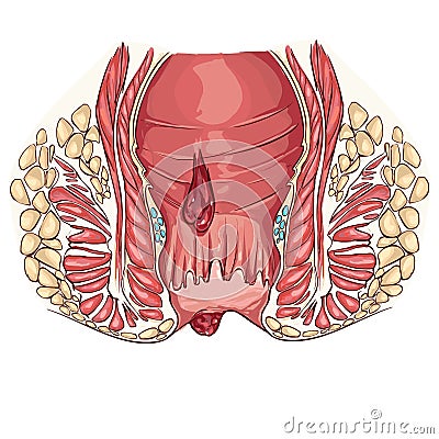 Hemorrhoid Vector Illustration