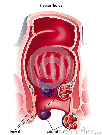 Hemorrhoids Vector Illustration