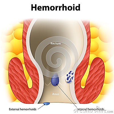 Hemorrhoids Vector Illustration