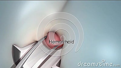 Hemorrhoid Surgery 3D Animation Stock Video - Video of hemorrhoid, canal:  119082643