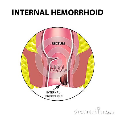 Hemorrhoids internal. Rectum structure. Intestines. colon. Internal hemorrhoidal node. Infographics. Vector illustration Vector Illustration