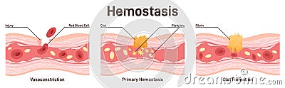 Hemostasis. Wound healing process stages, vasoconstriction and Vector Illustration