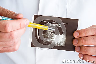 Hepatic or liver cyst on ultrasound image concept photo. Doctor indicating by pen on printed picture ultrasound pathology - hepati Stock Photo