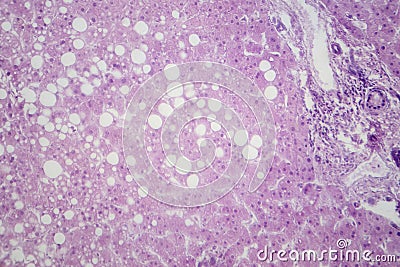 Hepatic steatosis, light micrograph Stock Photo