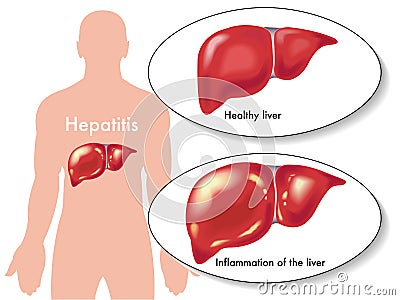 Hepatitis Vector Illustration