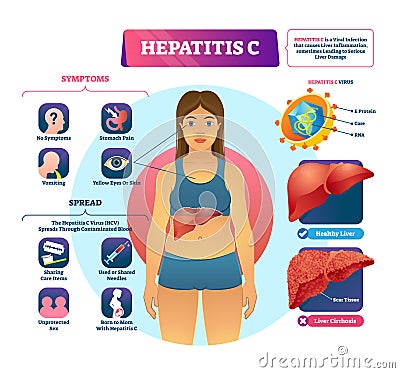 Hepatitis C vector illustration. Labeled viral infection explanation scheme Vector Illustration