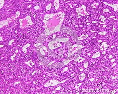 Hepatocellular carcinoma of a human Stock Photo