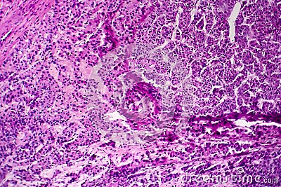 Hepatocellular carcinoma, light micrograph Stock Photo