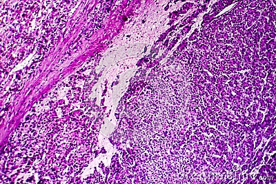 Hepatocellular carcinoma, light micrograph Stock Photo