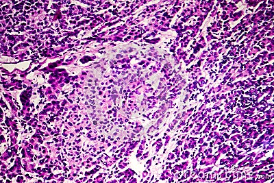 Hepatocellular carcinoma, light micrograph Stock Photo