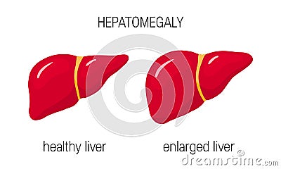 Hepatomegaly concept Cartoon Illustration