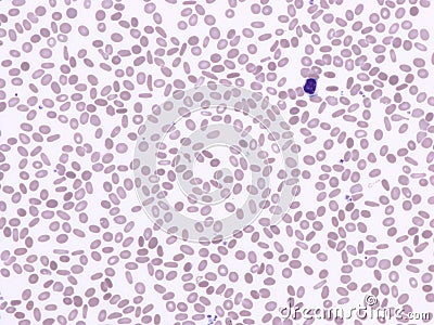 Hereditary elliptocytosis Stock Photo