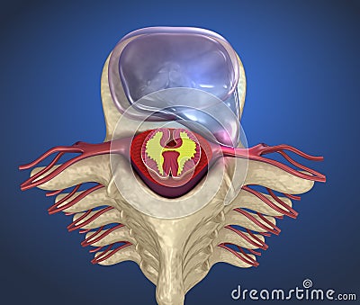 Hernaited disc in human spine in details Stock Photo