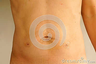 Hernia laparoscopy stomach keyhole surgery of Asian male 52.5 years old Stock Photo