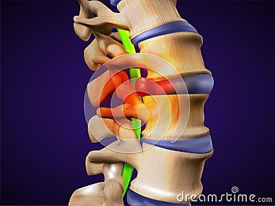 A herniated disc. Also called bulged, slipped or ruptured. Vector Illustration