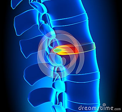 Herniated Disc Degeneration - Spine problem Stock Photo