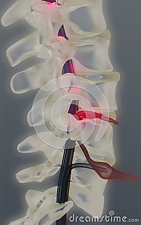 Herniated vertebral disk Stock Photo