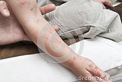 Herpes in a child arm. Stock Photo