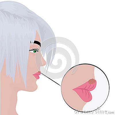 Herpes cold sores on woman`s lips Vector Illustration