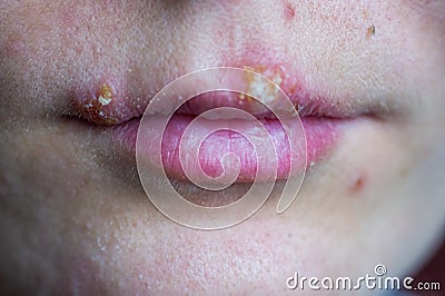 Herpes disease on the lips of a young girl Stock Photo