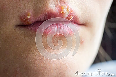 Herpes disease on the lips of a young girl Stock Photo