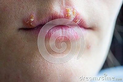 Herpes disease on the lips of a young girl Stock Photo