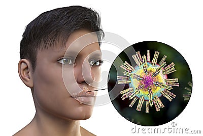 Herpes labialis, also known as cold sores Cartoon Illustration