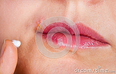 Herpes on the lip close-up macro. Woman lubricates the labial herpes ointment Stock Photo