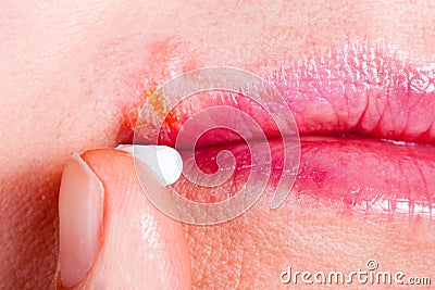 Herpes on the lip close-up macro. Woman lubricates the labial herpes ointment Stock Photo