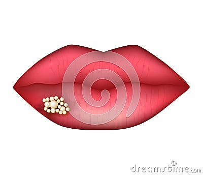 Herpes on the lip. Infographics. Vector illustration on isolated background. Vector Illustration