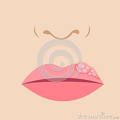 Herpes on the lip Vector Illustration