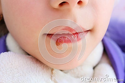 Herpes on lips of child. Treatment ointment Stock Photo