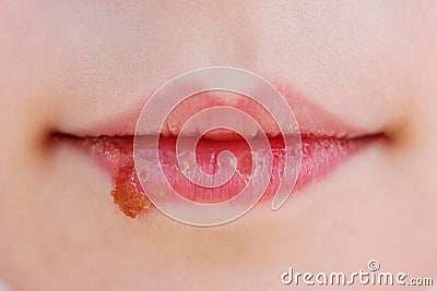 Herpes on lips of child. Treatment ointment Stock Photo