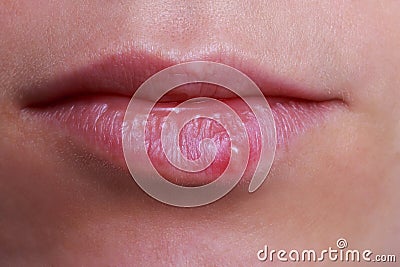 Herpes on the lips Stock Photo