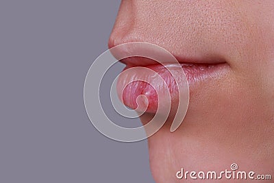 Herpes on the lips Stock Photo