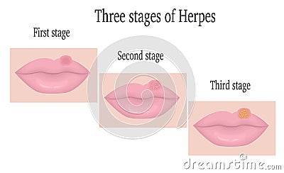 Herpes on the lips Vector Illustration