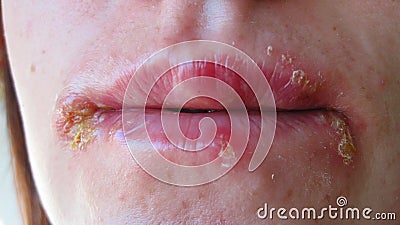 Herpes on lips Stock Photo