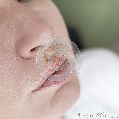 Herpes on the lips of the young woman Stock Photo