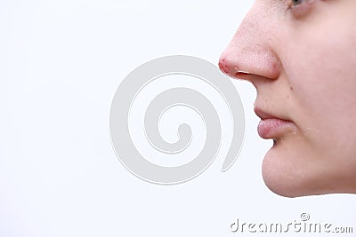 Herpes on the nose - Pretty young woman with herpes her on nose. Human Virus. Close Up of Nose with herpes simplex infection and Stock Photo